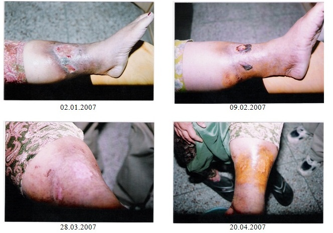 Ganoderma in Varicose Veins Ulcer - Case Study 1