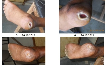 Role of Ganoderma in Diabetic foot (Gangrene)