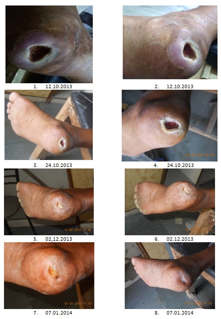 Role of Ganoderma in Diabetic foot (Gangrene)