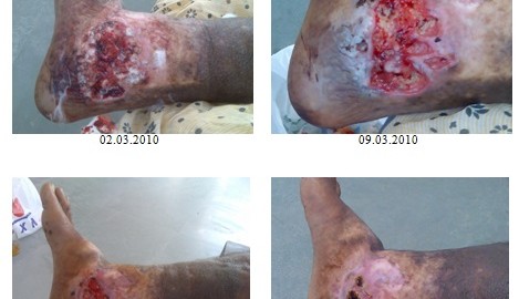 Ganoderma in Varicose Veins Ulcer - Case Study 2