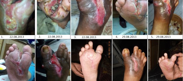 Role of Ganoderma in Diabetic Foot (gangrene)