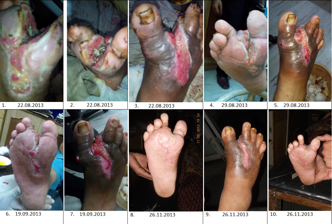 Role of Ganoderma in Diabetic Foot (gangrene)