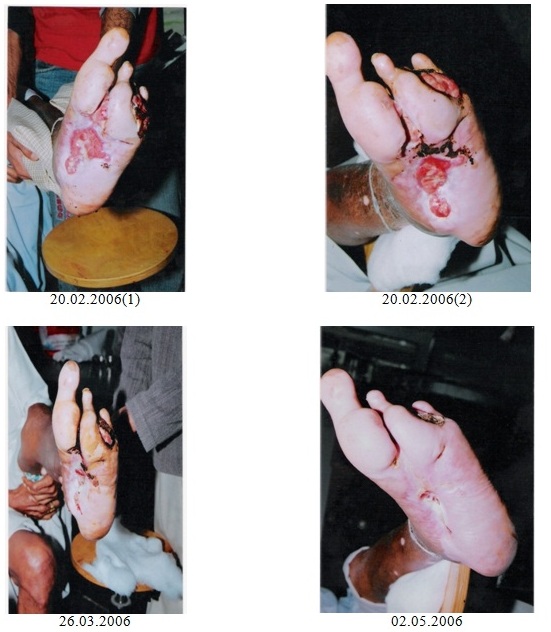 Ganoderma in Diabetic Foot - Case Study 1